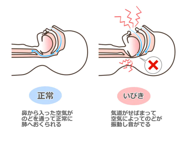 いびき