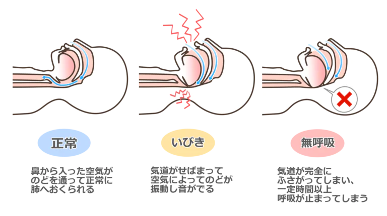 睡眠時無呼吸症候群